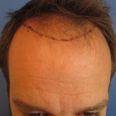 Before-Greffe de cheveux